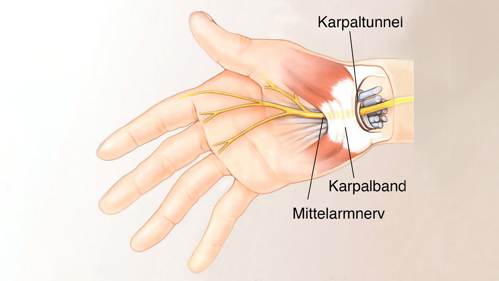 Karpaltunnel Syndrom