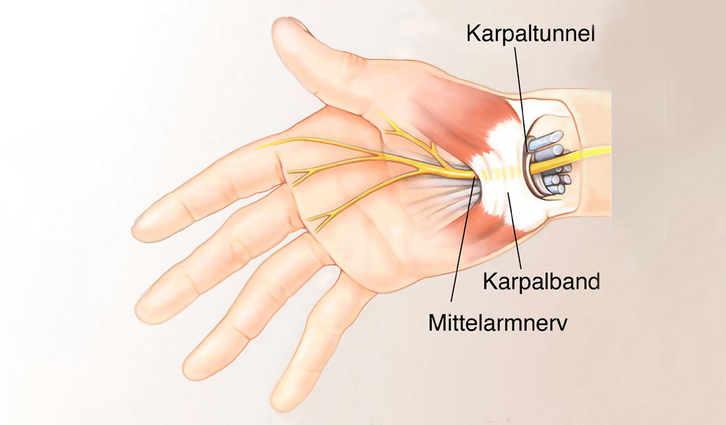 Karpaltunnel Syndrom